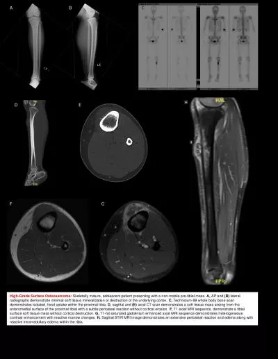 High-Grade Surface Osteosarcoma: