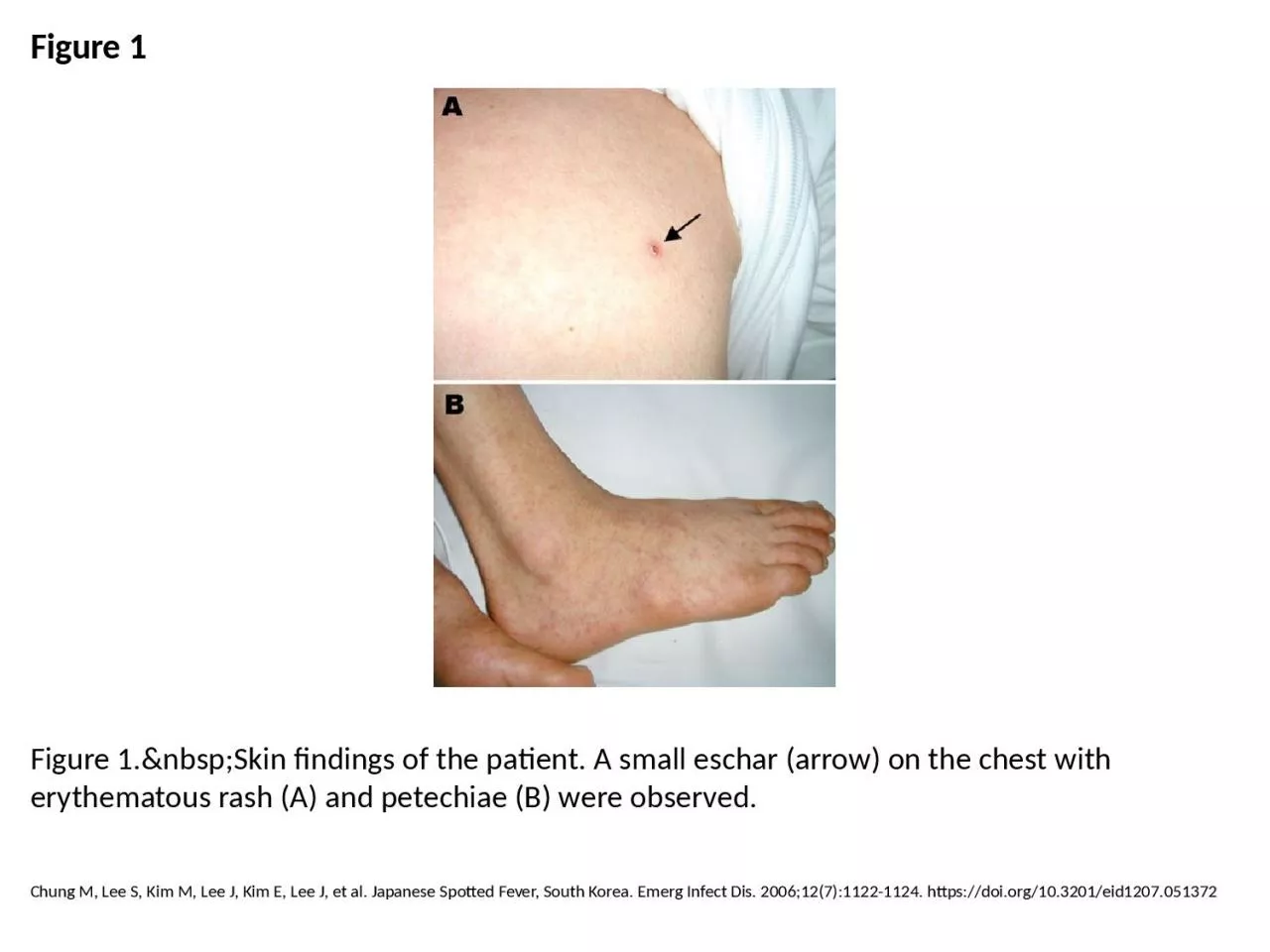 PPT-Figure 1 Figure 1.&nbsp;Skin findings of the patient. A small eschar (arrow) on the