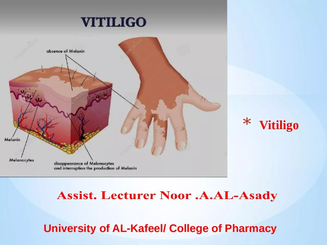 PPT-Vitiligo University of AL-