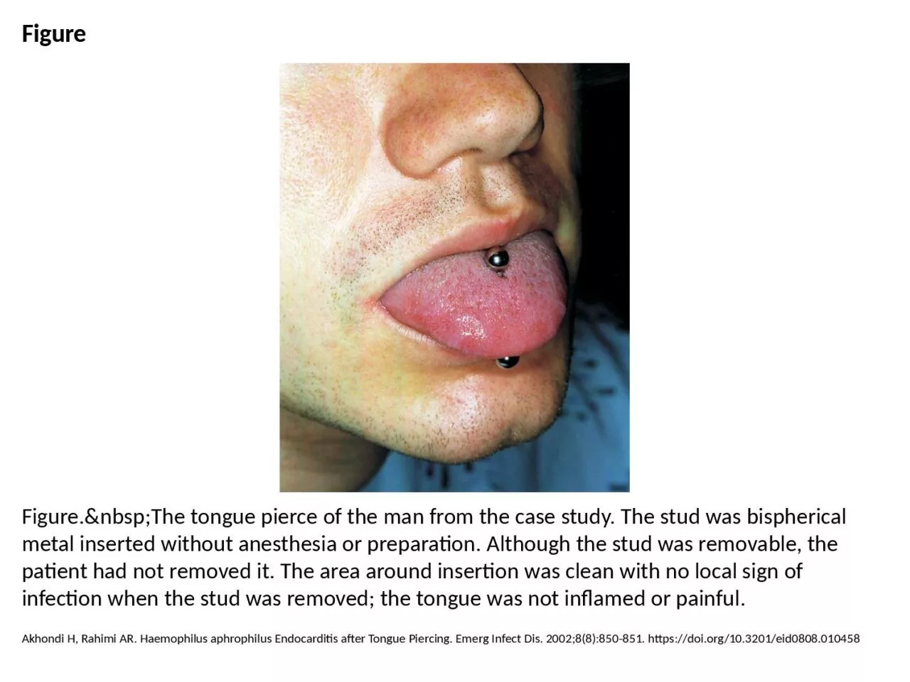 PPT-Figure Figure.&nbsp;The tongue pierce of the man from the case study. The stud was