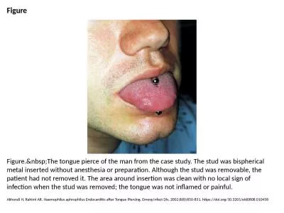 Figure Figure.&nbsp;The tongue pierce of the man from the case study. The stud was