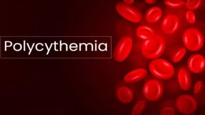 DEFINITION  Polycythemia is a blood disorder in which the body produces too many blood