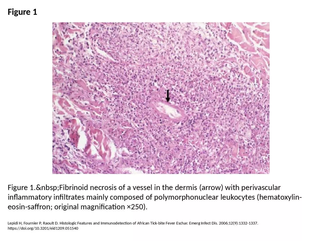 PPT-Figure 1 Figure 1.&nbsp;Fibrinoid necrosis of a vessel in the dermis (arrow) with