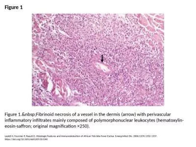 Figure 1 Figure 1.&nbsp;Fibrinoid necrosis of a vessel in the dermis (arrow) with