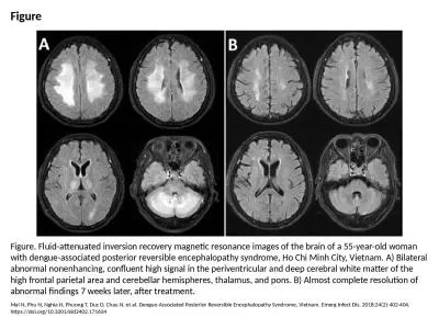 Figure Figure. Fluid-attenuated inversion recovery magnetic resonance images of the brain