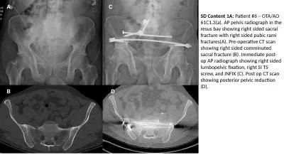 SD Content 1A:  Patient #6 – OTA/AO 61C1.3(a). AP pelvis radiograph in the resus bay showing righ