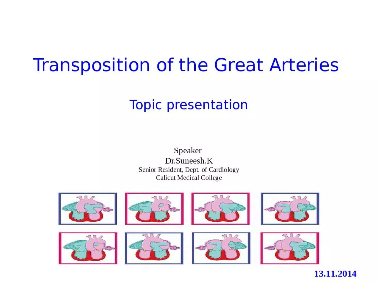 PPT-Transposition of the Great Arteries