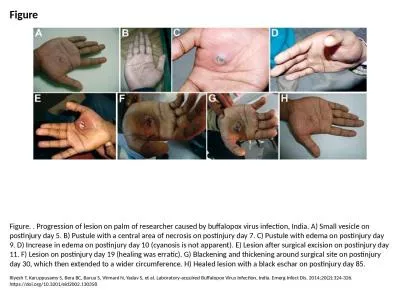 Figure Figure. . Progression of lesion on palm of researcher caused by buffalopox virus infection,