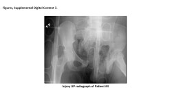 Injury AP radiograph of Patient #4