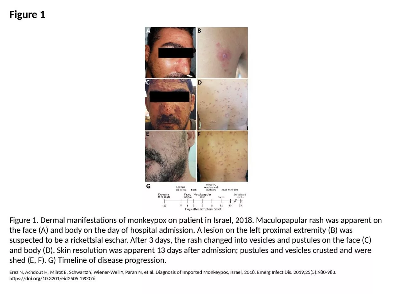 PPT-Figure 1 Figure 1. Dermal manifestations of monkeypox on patient in Israel, 2018. Maculopapular