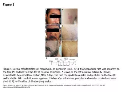 Figure 1 Figure 1. Dermal manifestations of monkeypox on patient in Israel, 2018. Maculopapular ras