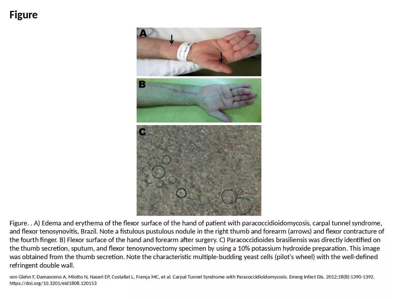 Figure Figure. . A) Edema and erythema of the flexor surface of the hand of patient with