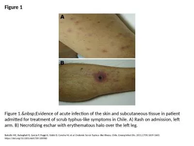 Figure 1 Figure 1.&nbsp;Evidence of acute infection of the skin and subcutaneous tissue