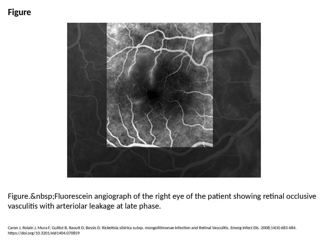 PPT-Figure Figure.&nbsp;Fluorescein angiograph of the right eye of the patient showing