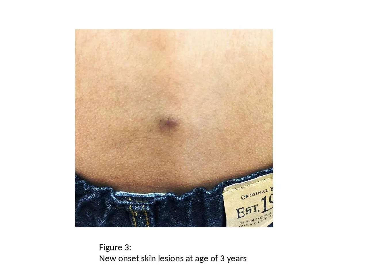 PPT-Figure 3 : New onset skin lesions at age of 3 years