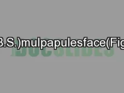 presenteddermatologist(B.S.)mulpapulesface(FigureThepapulesclinicallyb