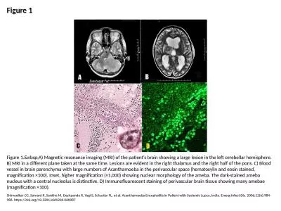 Figure 1 Figure 1.&nbsp;A) Magnetic resonance imaging (MRI) of the patient's brain showing a la