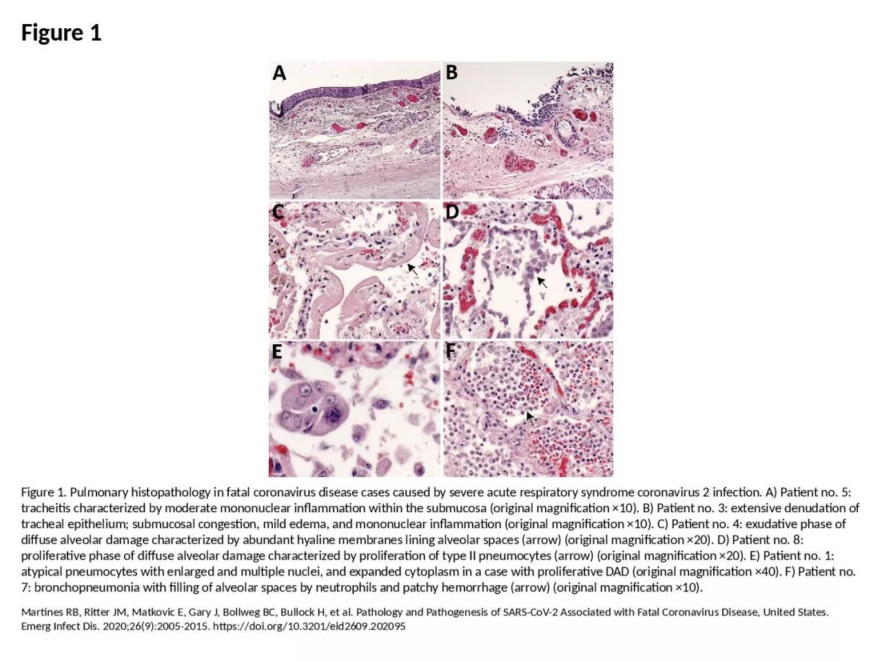 PPT-Figure 1 Figure 1. Pulmonary histopathology in fatal coronavirus disease cases caused