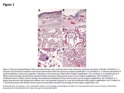 Figure 1 Figure 1. Pulmonary histopathology in fatal coronavirus disease cases caused by severe acu