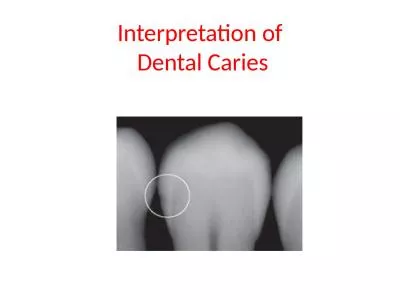 Interpretation  of   Dental Caries
