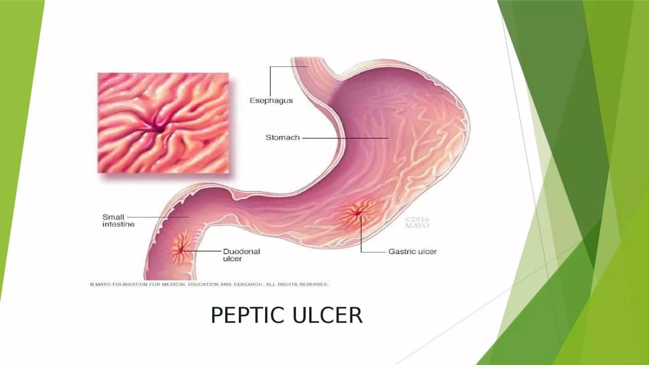 PPT-PEPTIC ULCER PEPTIC ULCER