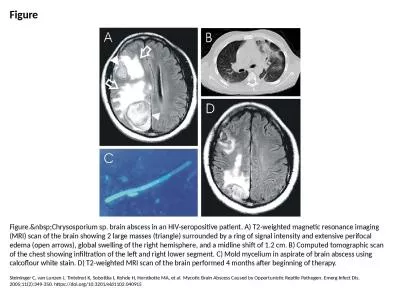 Figure Figure.&nbsp;Chrysosporium sp. brain abscess in an HIV-seropositive patient.