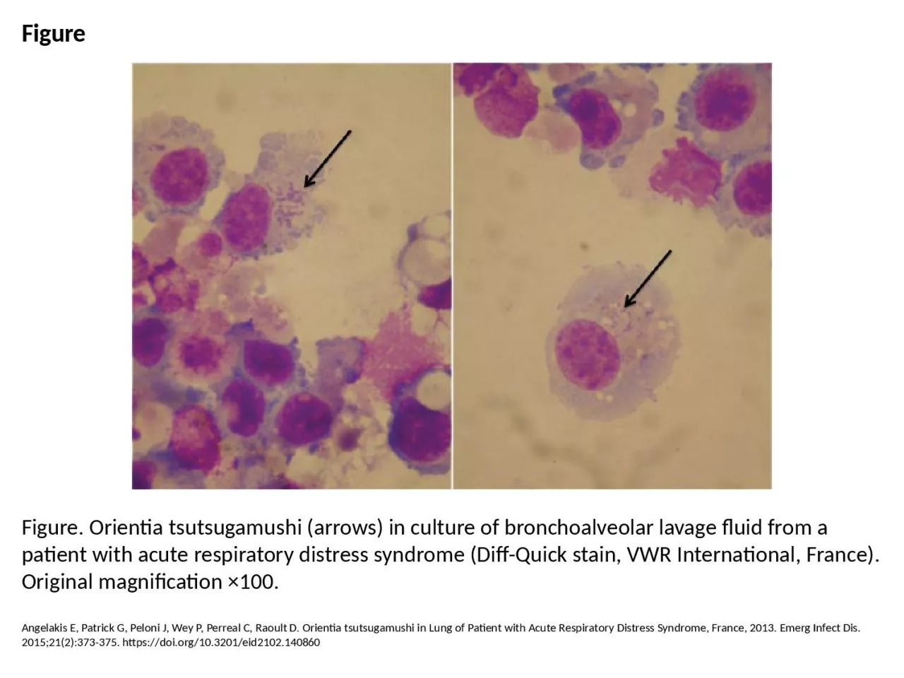 PPT-Figure Figure. Orientia tsutsugamushi (arrows) in culture of bronchoalveolar lavage fluid