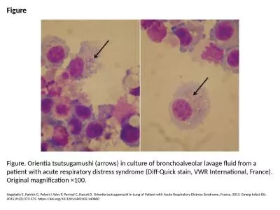 Figure Figure. Orientia tsutsugamushi (arrows) in culture of bronchoalveolar lavage fluid