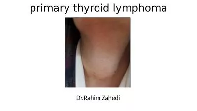 primary thyroid lymphoma