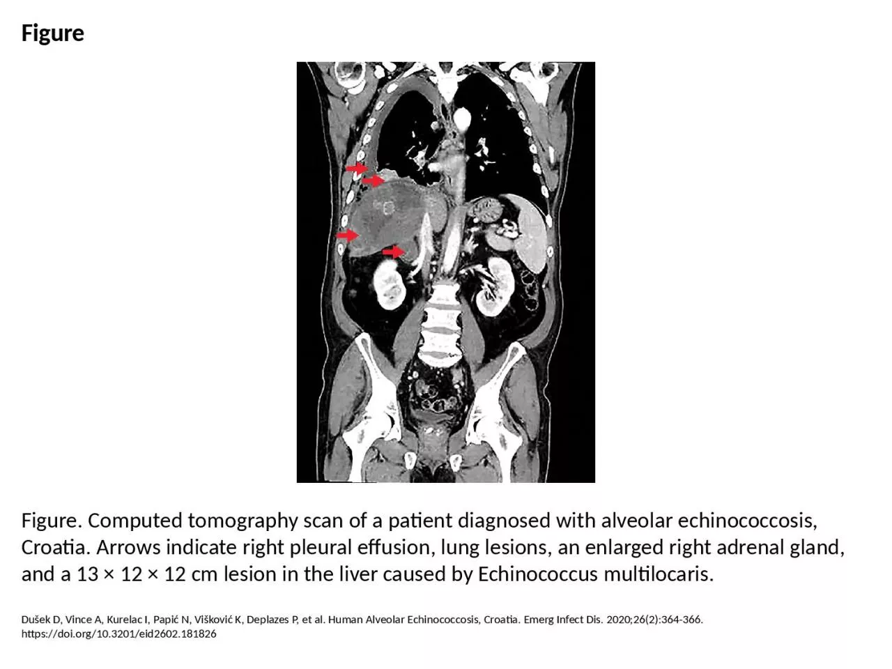 PPT-Figure Figure. Computed tomography scan of a patient diagnosed with alveolar echinococcosis,