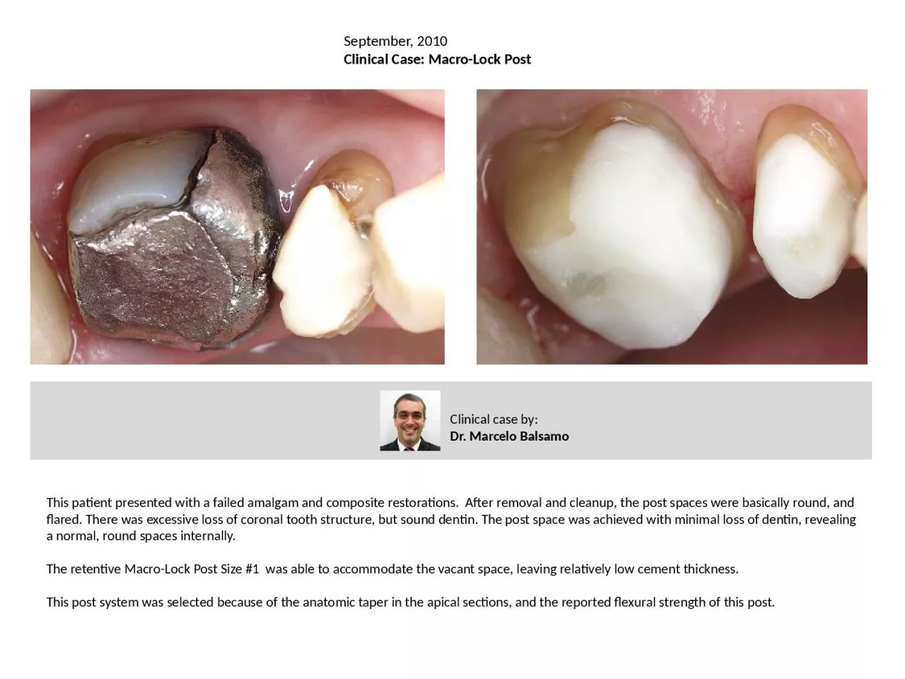 This patient presented with a failed amalgam and composite restorations.  After removal