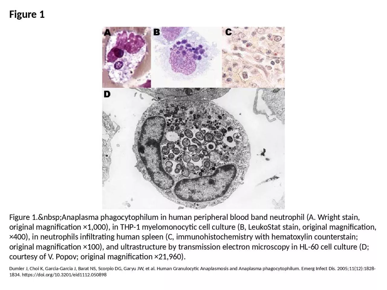 PPT-Figure 1 Figure 1.&nbsp;Anaplasma phagocytophilum in human peripheral blood band neutrophil