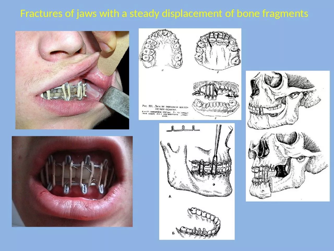 PPT-Fractures of jaws with a steady displacement of bone fragments