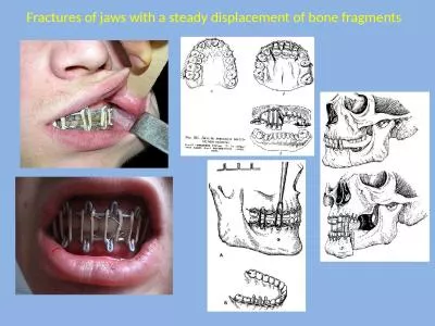 Fractures  of jaws with a steady displacement of bone fragments