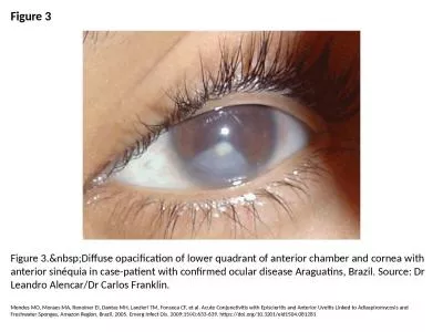 Figure 3 Figure 3.&nbsp;Diffuse opacification of lower quadrant of anterior chamber