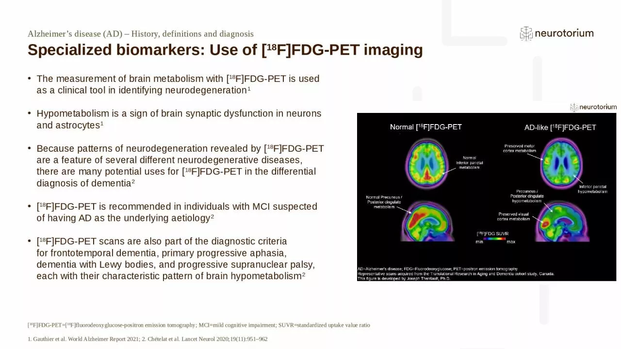 PPT-Alzheimer’s disease (AD) – History, definitions and diagnosis