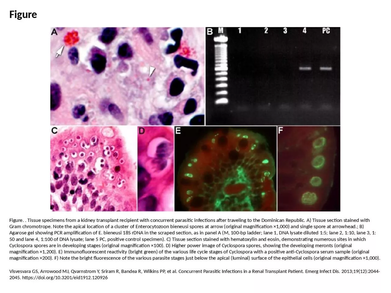 PPT-Figure Figure. . Tissue specimens from a kidney transplant recipient with concurrent parasitic