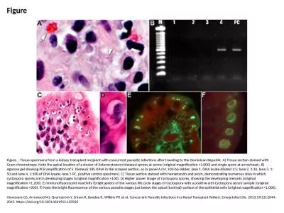 Figure Figure. . Tissue specimens from a kidney transplant recipient with concurrent parasitic infe