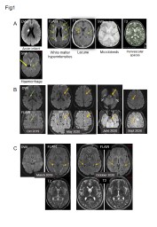 Fig1 White matter  hyperintensities