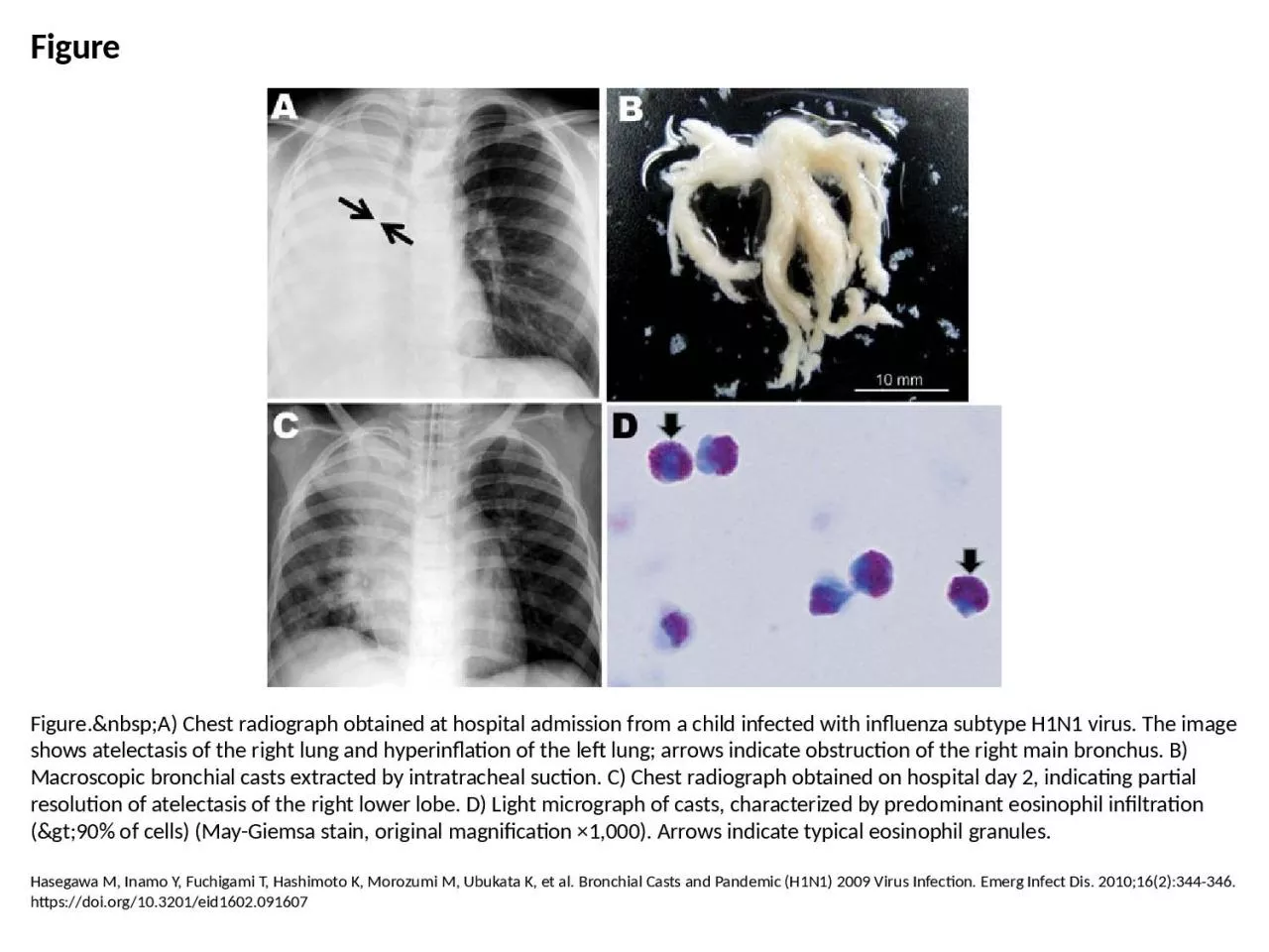 PPT-Figure Figure.&nbsp;A) Chest radiograph obtained at hospital admission from a child