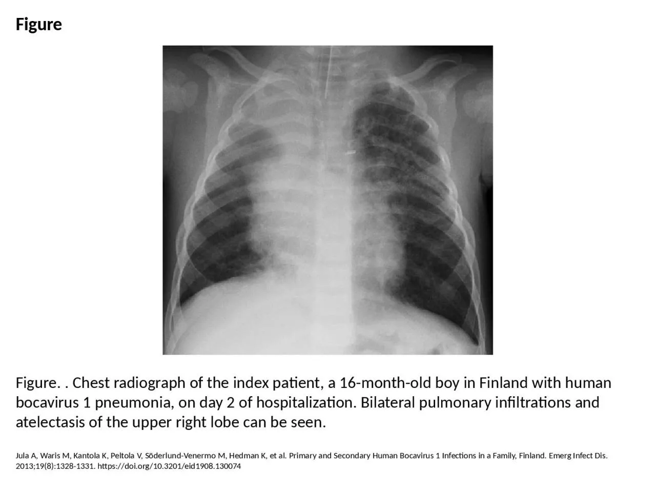 PPT-Figure Figure. . Chest radiograph of the index patient, a 16-month-old boy in Finland