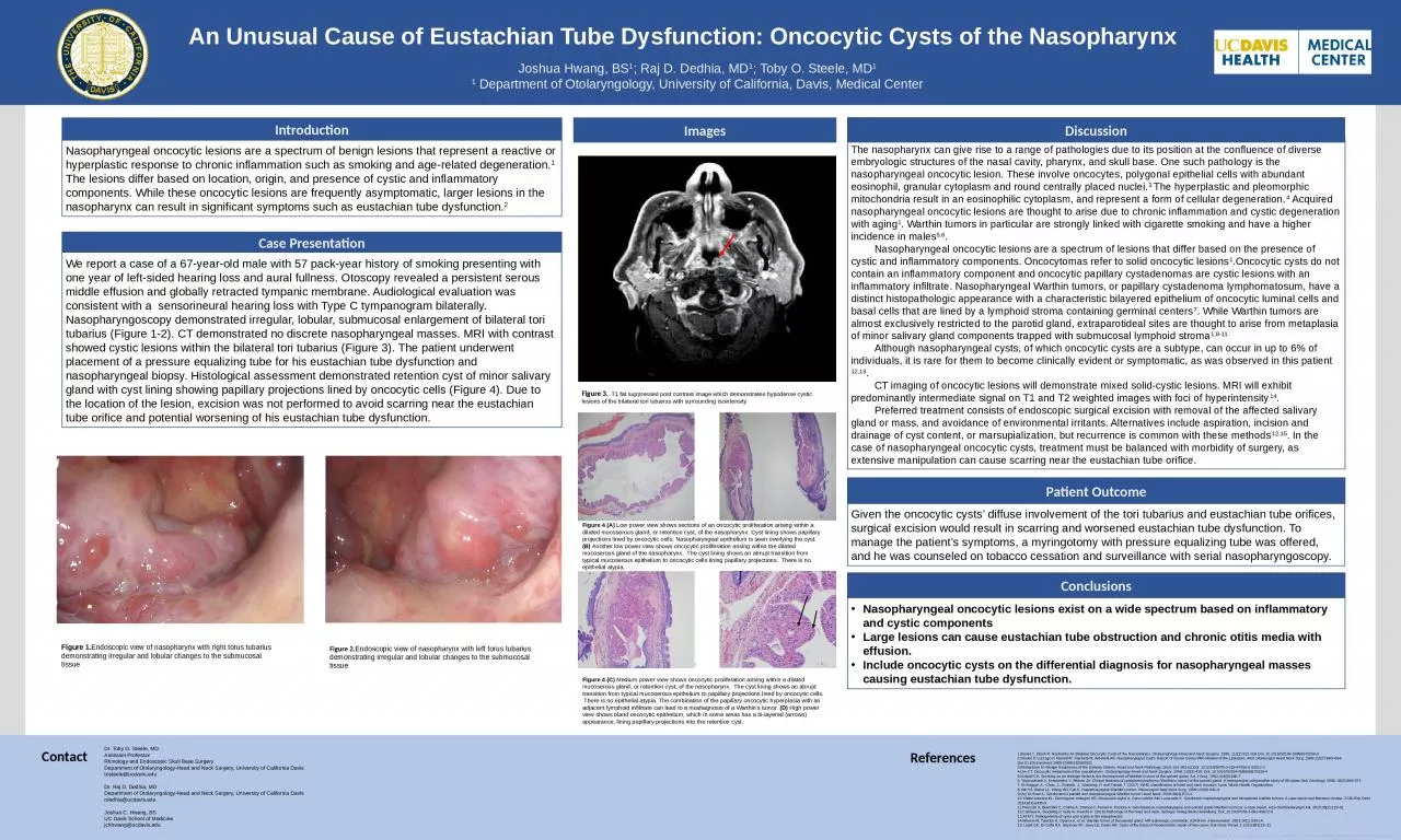 PPT-An Unusual Cause of Eustachian Tube Dysfunction: Oncocytic Cysts of the Nasopharynx