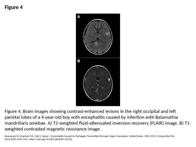 Figure 4 Figure 4. Brain images showing contrast-enhanced lesions in the right occipital