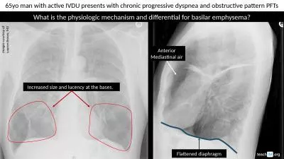 65yo man with active IVDU presents with chronic progressive dyspnea and obstructive pattern PFTs