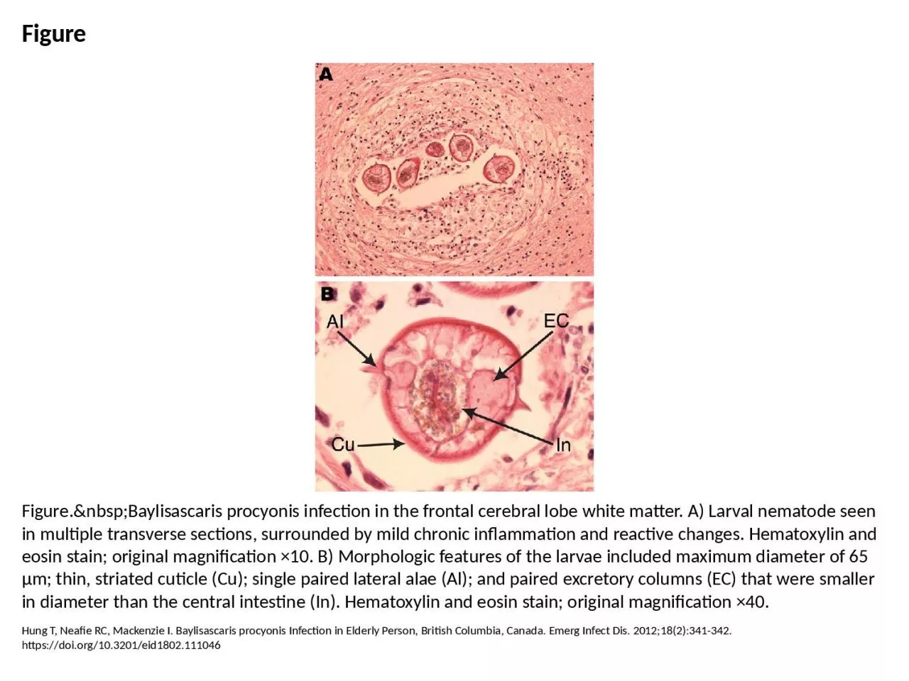 PPT-Figure Figure.&nbsp;Baylisascaris procyonis infection in the frontal cerebral lobe