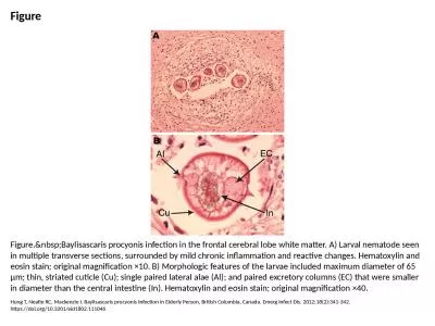 Figure Figure.&nbsp;Baylisascaris procyonis infection in the frontal cerebral lobe white matter