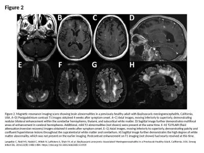 Figure 2 Figure 2. Magnetic resonance imaging scans showing brain abnormalities in a previously