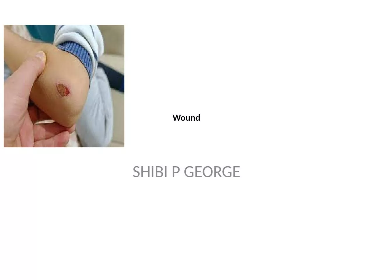 PPT-Wound SHIBI P GEORGE WOUND