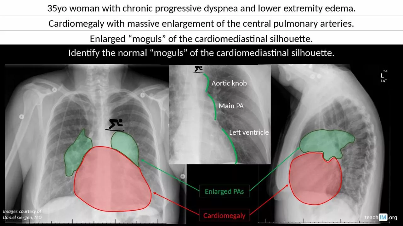 PPT-35yo woman with chronic progressive dyspnea and lower extremity edema.