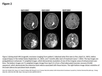 Figure 2 Figure 2.&nbsp;Axial MRI (magnetic resonance imaging) from patient 2 obtained when fir